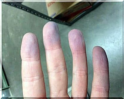 Fingers with cyanosis.