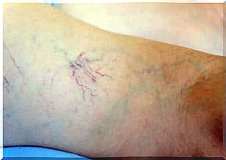 Venous insufficiency in a woman.