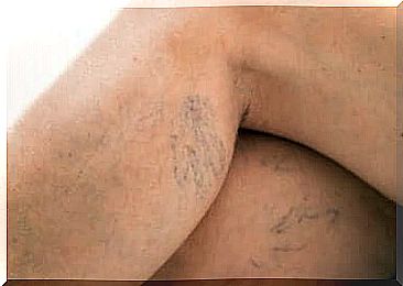 A woman who has varicose veins.