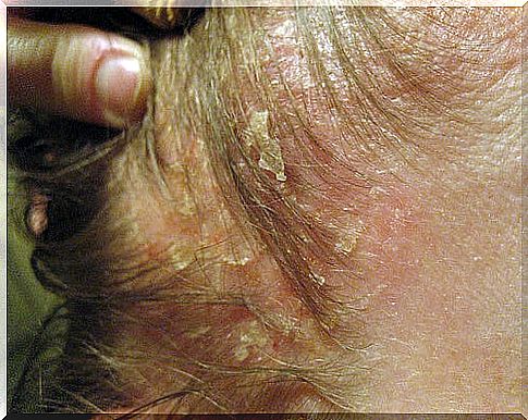 example of seborrheic dermatitis