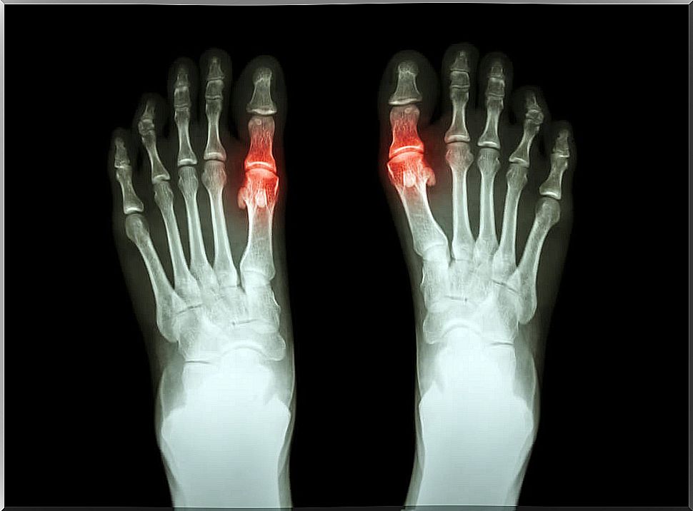 Arthritis can consist of inflammation of the joint of the big toes