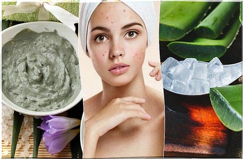 How To Treat Pimples On Your Nose With 4 Home Remedies