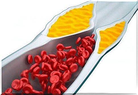 Cholesterol in the arteries.