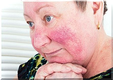 A woman with rosacea 