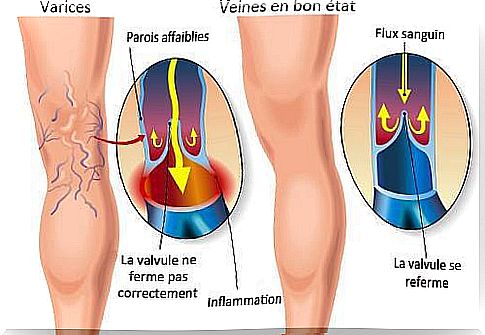 varicose veins