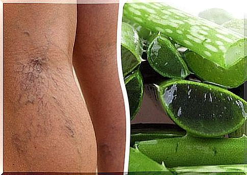 Aloe vera remedy to treat varicose ulcers